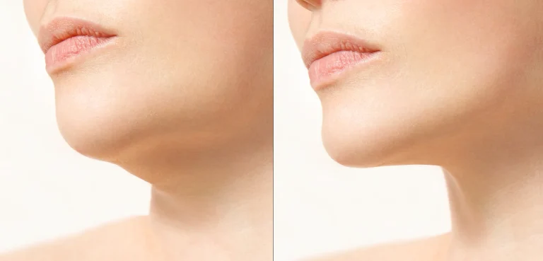 Advantages and Disadvantages of Chin Liposuction