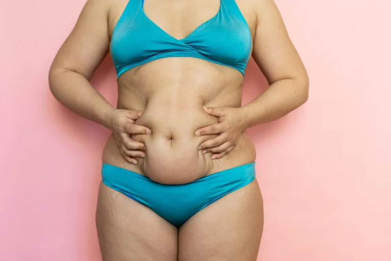 What you need to know about Tummy Tuck?