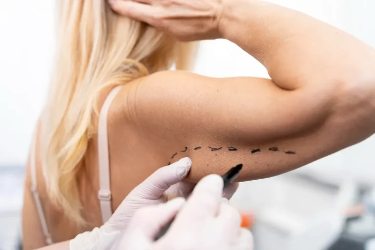 Exploring the Benefits of Arm Lift Surgery: A Comprehensive Guide