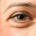 Eyelid Surgery in Türkiye vs the UK: Popularity and Trends Compared