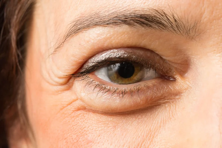 Eyelid Surgery in Türkiye vs the UK: Popularity and Trends Compared