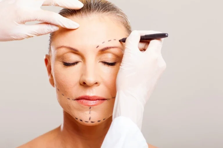 What Is a Facelift? Who Is It Suitable For?