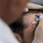 Does Hair Transplant Leave Scars?