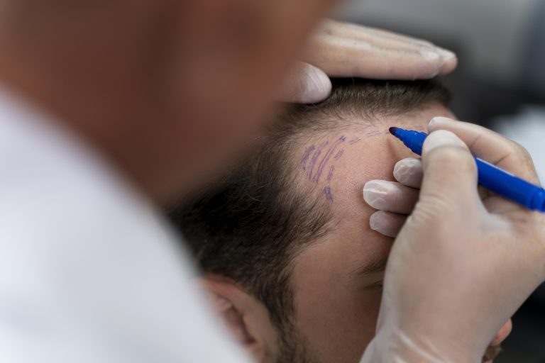 Does Hair Transplant Leave Scars?