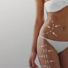 Comparison Between Turkey and the United Kingdom: Popularity and Trends in Vaser Liposuction (Fat Removal)