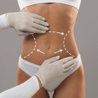 When Are Vaser Liposuction Results Visible? Recovery Process and Expectations