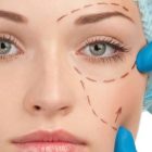 Procedures That Can Be Combined with Blepharoplasty (Eyelid Surgery)