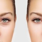 Top 10 Most Frequently Asked Questions About Eyelid Surgery (Blepharoplasty)