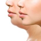 Double Chin Surgery Preparation Guide: What Should You Know Before the Procedure?