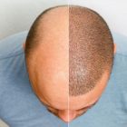 Will Hair Transplant Leave Scars? What You Should Know About Scarring and the Healing Process After Hair Transplant