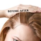 Hair Transplant Recovery Process and Post-Operative Care Guidelines