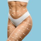Body Contouring: Pre- and Post-Operative Care Plan